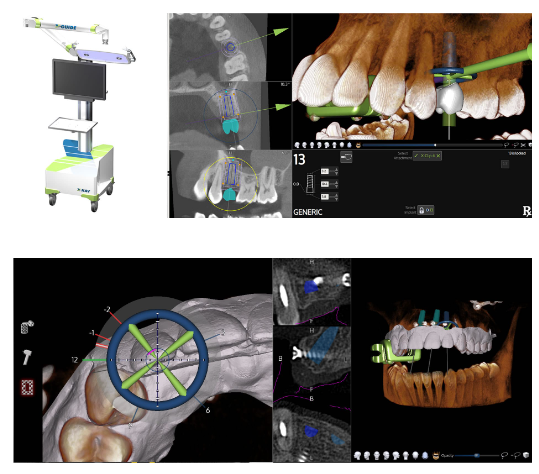 네비게이션 임플란트 1