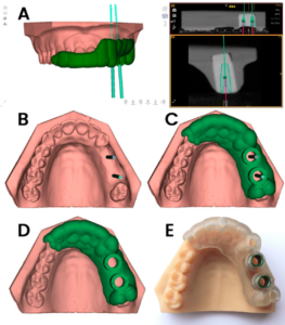 네비게이션 임플란트 2