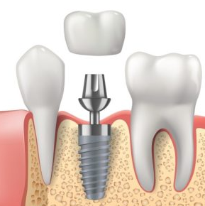 덴티움 임플란트 1
