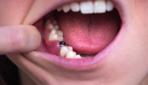 스트라우만 임플란트 1