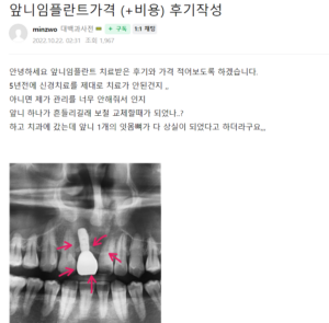 앞니 임플란트 후기 4