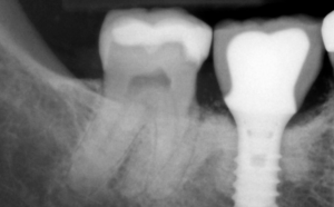 어금니 임플란트 1
