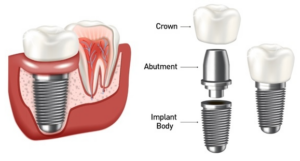 임플란트 구성요소
