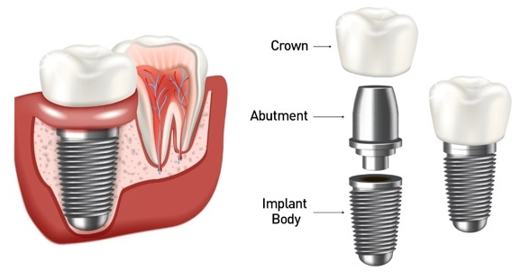 임플란트 구성요소