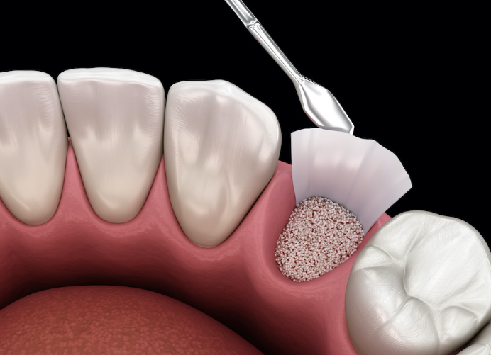 임플란트 뼈이식