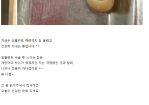 임플란트 수술 후기3