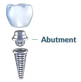 임플란트 어버트먼트