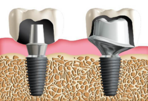 임플란트 어버트먼트란 2