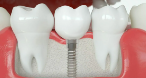 임플란트 크라운