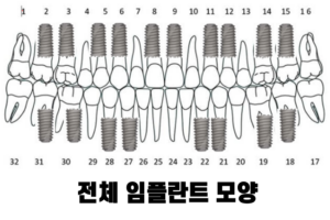 전체 임플란트 모양 2