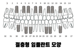 절충형 임플란트 모양 1
