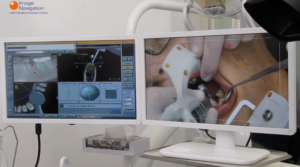 디지털 임플란트