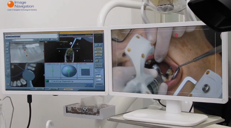 디지털 임플란트