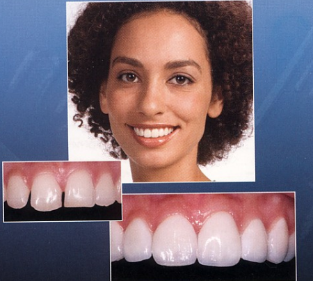 무삭제 라미네이트 1