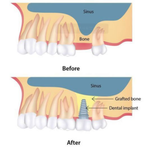 상악동 거상술 1