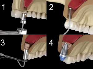 상악동 거상술 진행 과정