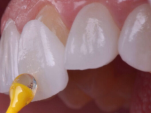 앞니 라미네이트