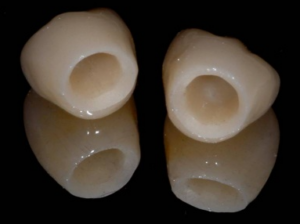 앞니 올세라믹 크라운 2 1