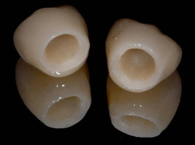 앞니 올세라믹 크라운 2 1