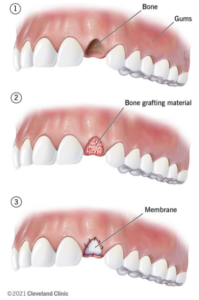 잇몸 뼈이식 2 1