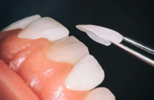 치아 라미네이트 2