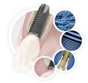 아스트라 임플란트