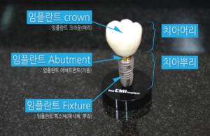 임플란트 보철물