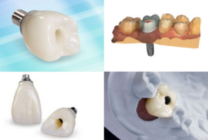 임플란트 보철물 타입