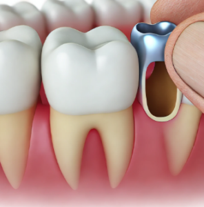 임플란트-1개-가격
