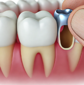 임플란트-1개-가격