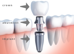 임플란트-구성요소