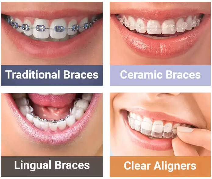 성인-치아-교정