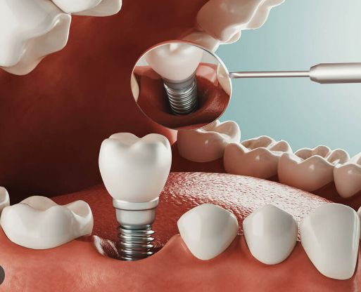 원데이-임플란트