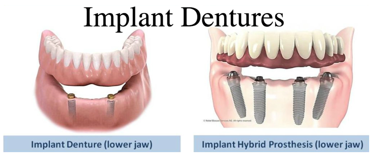 임플란트-틀니-종류