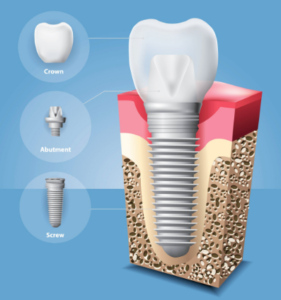 임플란트－구조