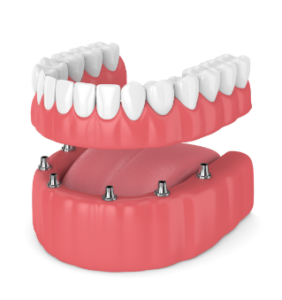 전체－임플란트－구조