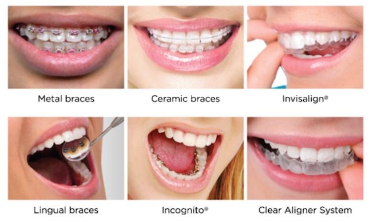 치아-교정-종류