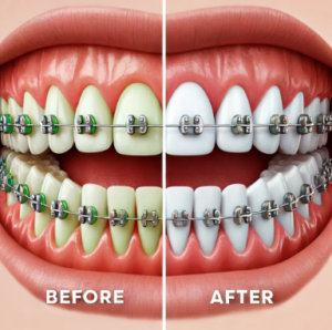 치아-교정-후기