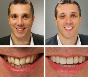 치아-교정-전후-3