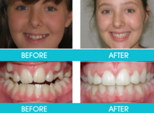 치아-교정-전후-2