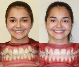 치아-교정-전후