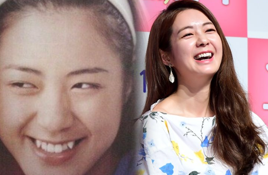 치아 교정 전후-이요원