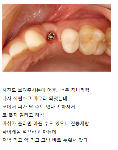 임플란트 후기 5