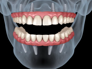 all-in-4-임플란트 (1)