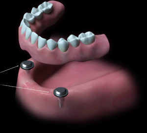 오버덴처-임플란트 (1)