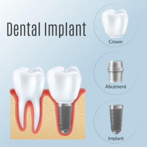 임플란트-구성요소