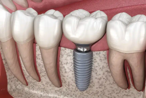 전체-임플란트 (1)