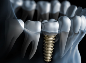 전체-임플란트 (3)