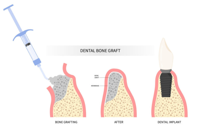 임플란트-뼈이식